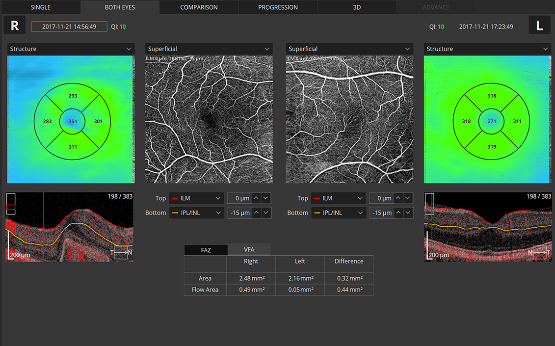 ANGIOGRAPHY OCT Both eyes Retina Angio view