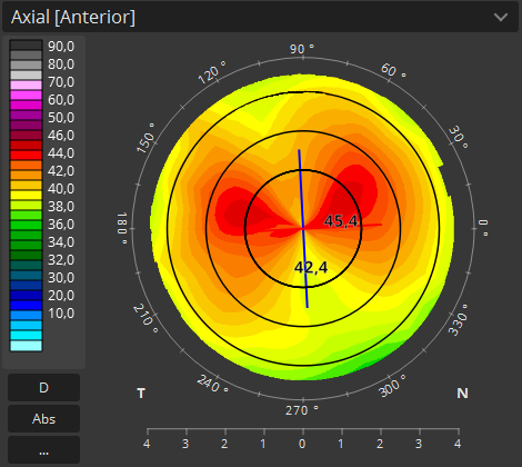 TOPOGRAPHY astigmatism