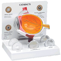 Cataract Eye Model
