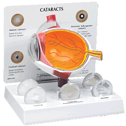 Cataract Eye Model